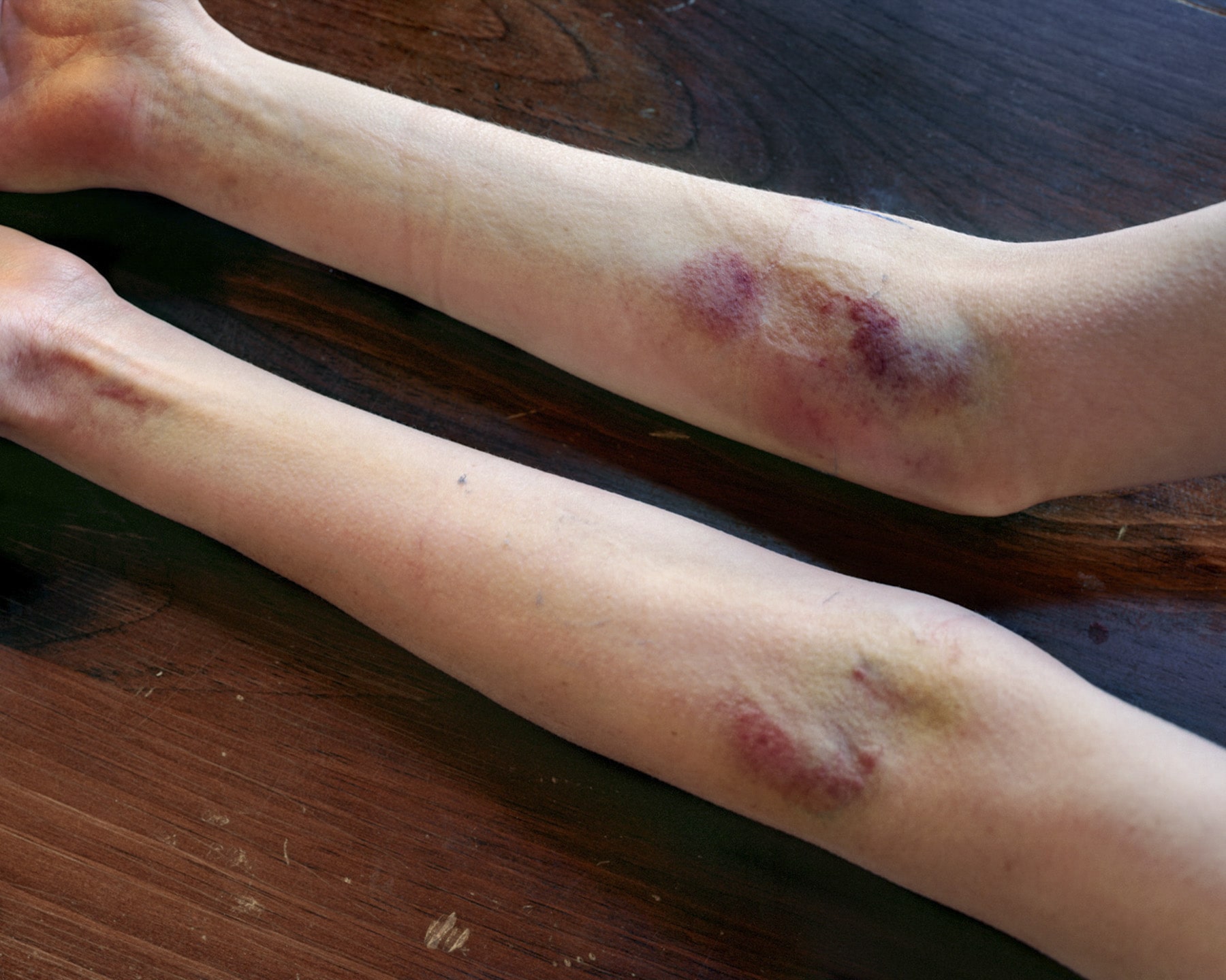 IV Bruises